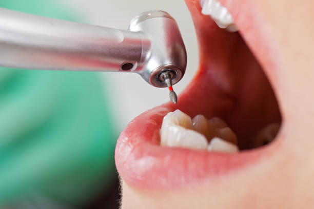 Best Emergency Tooth Extraction in Plain City, OH